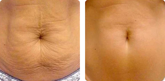 <h4><strong>Reduce la flacidez</strong></h4>