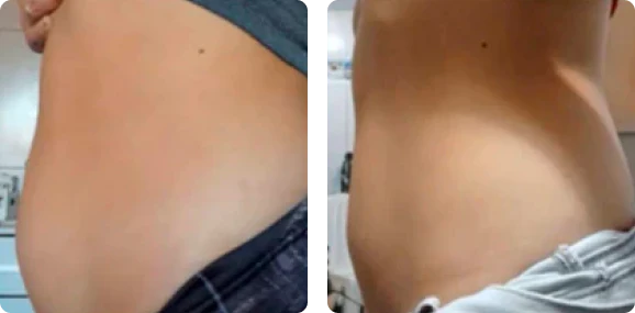 <h4><strong>Atenúa estrías blancas</strong></h4>