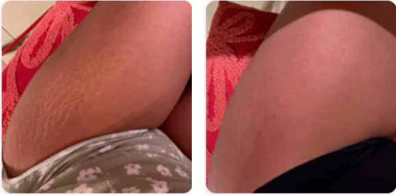 <h4><strong>Suaviza estrías postparto en el abdomen</strong></h4>