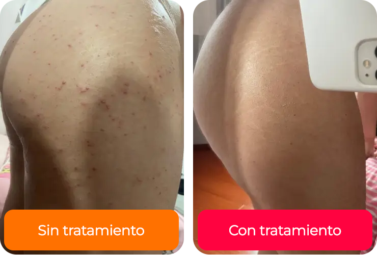 <h4><strong>Reduce la flacidez</strong></h4>