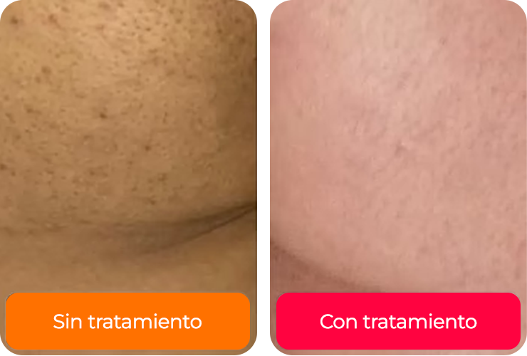 <h4><strong>Suaviza estrías postparto en el abdomen</strong></h4>